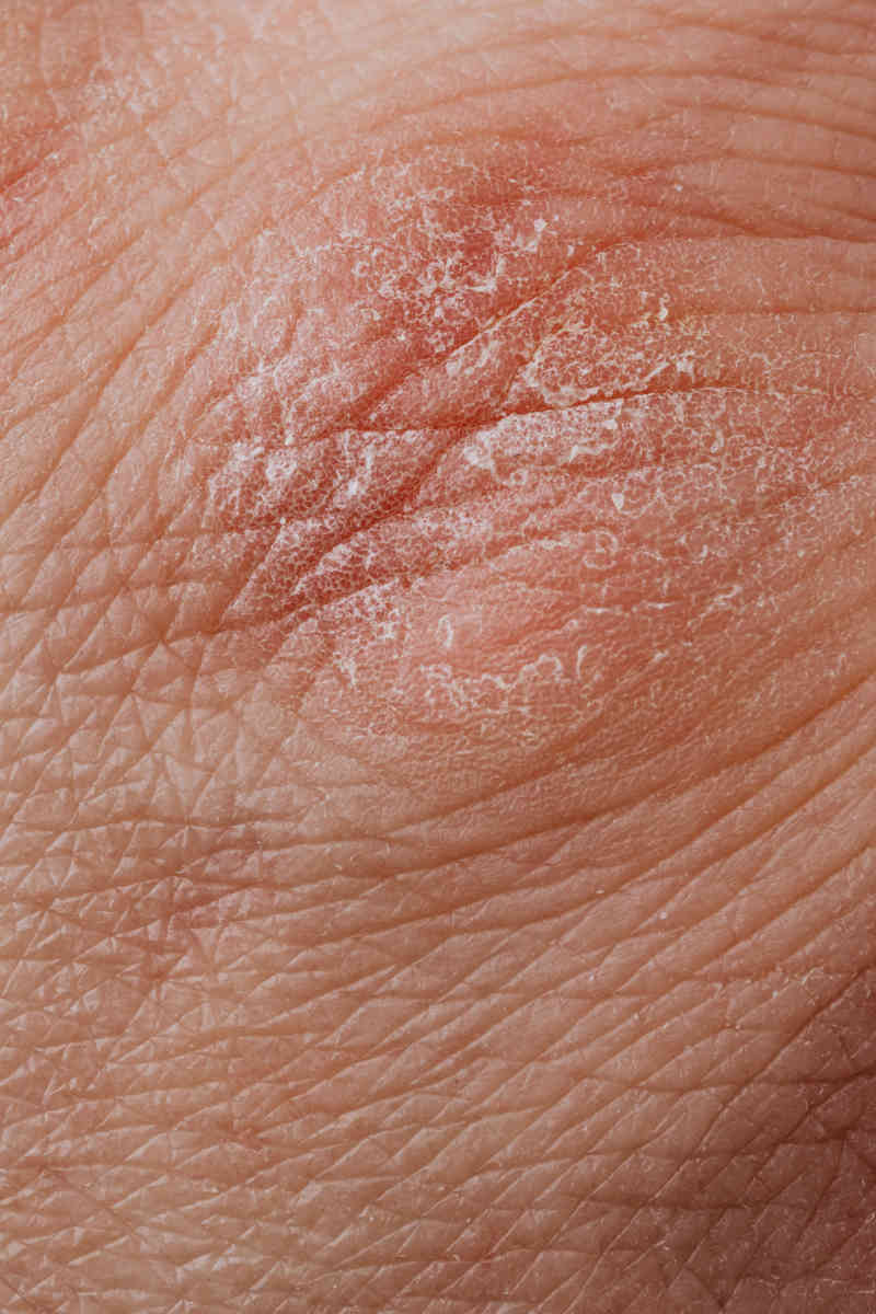 Haarpflege Schuppen Ekzeme Neurodermitis